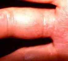 Herpesul pe mâini (criminalul herpetic): cauze, simptome, tratament