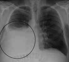 Hidrotaraxul pulmonar: cauze, simptome și tratamente