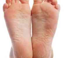 Hyperkeratoza picioarelor: tratament cu remedii folclorice