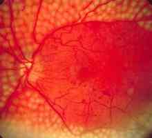 Angiopatia retiniană angiotensină: simptome și regim de tratament