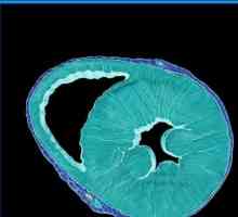 Hipertrofia ventriculului stâng: ce este? Cauze, simptome și metode de tratament