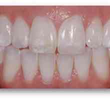 Hipoplazia smalțului dinților: diagnostic și tratament