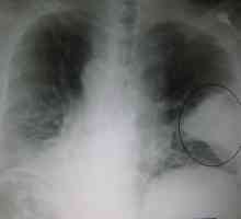Pneumonia hipostatică: cauze și diagnostic