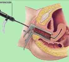 Histeroscopia uterului - ce este? Histeroscopia uterului: tipurile, indicațiile, costul procedurii