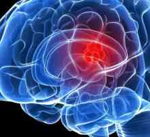 Dureri de cap: o tumoare pe creier. Primele simptome ale unei tumori cerebrale