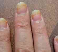 Ciuperca pe unghiile mâinilor: o descriere a bolii și a tratamentului