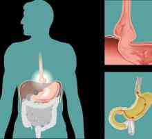 Hernia deschiderii esofagiene a diafragmei: semne, simptome, tratament, dietă