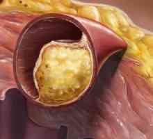 Plachetele de colesterol din vase: cauzele formării, simptomele, consecințele. Cum sa curatati…