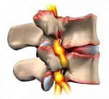 Chondroza coloanei vertebrale lombare: simptome, tratament, cauze și diagnostic
