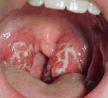 Boala cronică a gâtului: cauze, tratament, complicații