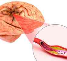 Ischemie cerebrală cronică: cauze și tratament
