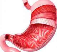 Gastrita superficială cronică: simptome, tratament, dietă