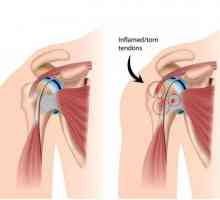 Sindromul de impingere a articulației umărului: tratament, cauze, diagnostice