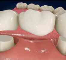 Implant sau pod - care este mai bine? Implanturi dentare. Proteză dentară