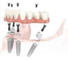Implanturile dinților: contraindicații, recenzii, rău