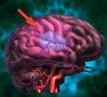 Accident vascular cerebral al creierului: prevenire. Remedii populare pentru prevenirea…