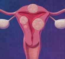 Miomă uterină interstițială - caracteristică