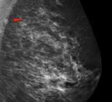 Nodul limfatic intramamar al sânului: ce este, descrierea, cauzele și caracteristicile tratamentului