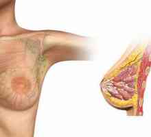 Cancerul de sân invaziv: cauze, diagnostic, tratament. Sânge pe oncomeriști