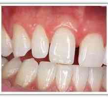 Corectarea ocluziunii la adulți. Dinți sănătoși - dinți frumoși