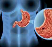 Ulcerul de stomac: cauze, simptome, diagnostice și standarde de tratament