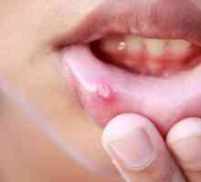 Ulcere în gură: cauze și tratament