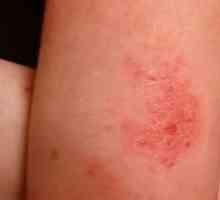 Eczema: ce este, cauzele apariției, tipurile și tratamentul