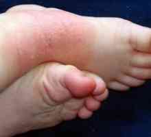 Eczemă pe picioare: simptome și tratament