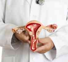 Endometrioza acută: simptome și tratament