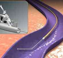 Coagulare laser endovasal a venelor