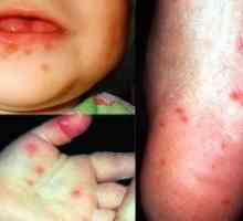 Infecția cu enterovirus la un copil: tratament, simptome, prevenire