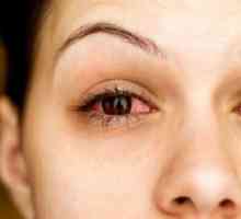 Episclerita oculară: semne, cauze, tratament
