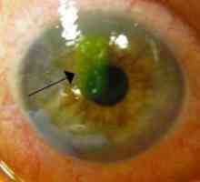 Eroziunea corneei ochiului: simptome, cauze și tratament