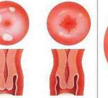 Eroziunea cervixului la fetele nulipare: cauze, simptome, tratament
