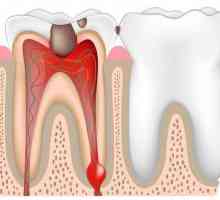 Etapele tratamentului pulpitei cu medicamente. Tratamentul endodontic