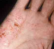 Cum este diagnosticat și tratat eczemul dishidrotic?