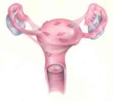 Cum se trateaza endometrioza? Endometrioza uterului: ce este și cum să vă protejați de această boală