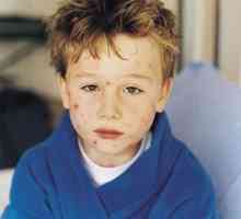 Cum se trateaza varicela la copii? Simptomele și recomandările de tratament
