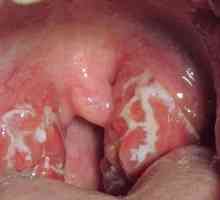 Cum de a trata herpesul în gât la copii?