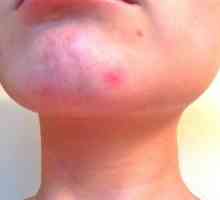 Cum se trateaza acneea chistica?