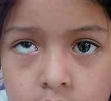 Care este numele bolii, atunci când ochii privesc în direcții diferite?