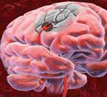 Cum se determină tulburarea circulației cerebrale: simptome, tratament