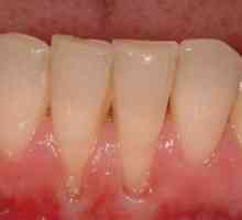 Cum să preveniți gingivita - cauze posibile și caracteristici ale tratamentului