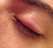 Cum se elimină umflarea din ochi? Pași simpli pentru o privire radiantă