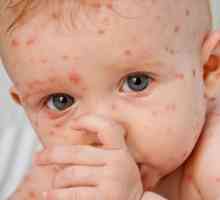 Cum se dezvoltă copilul varicela? Primele semne