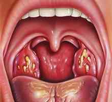 Cum arata angina pectorala? Tipuri și simptome de durere în gât