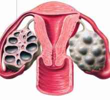 Cum arată ovarul multifollicular și ar trebui tratat?