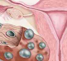 Cum să rămâneți gravidă cu ovare polichistice? Simptomele și tratamentul ovarelor polichistice,…