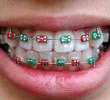 Care sunt bretelele pe dinți: tipuri, caracteristici și recenzii
