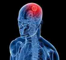 Care este primul semn al unui simptom al cancerului de creier?